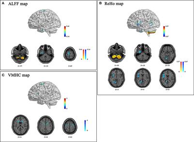 Evaluation of altered brain activity in type 2 diabetes using various indices of brain function: A resting-state functional magnetic resonance imaging study